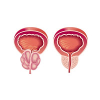 Простатит: определение, виды, симптомы, причины, диагностика и использование БАДов в лечении