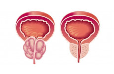 Простатит: определение, виды, симптомы, причины, диагностика и использование БАДов в лечении